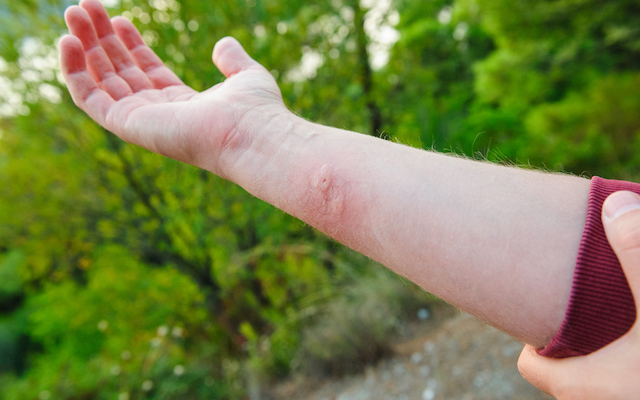 When Do Bug Bites Need Medical Attention? - MeMD